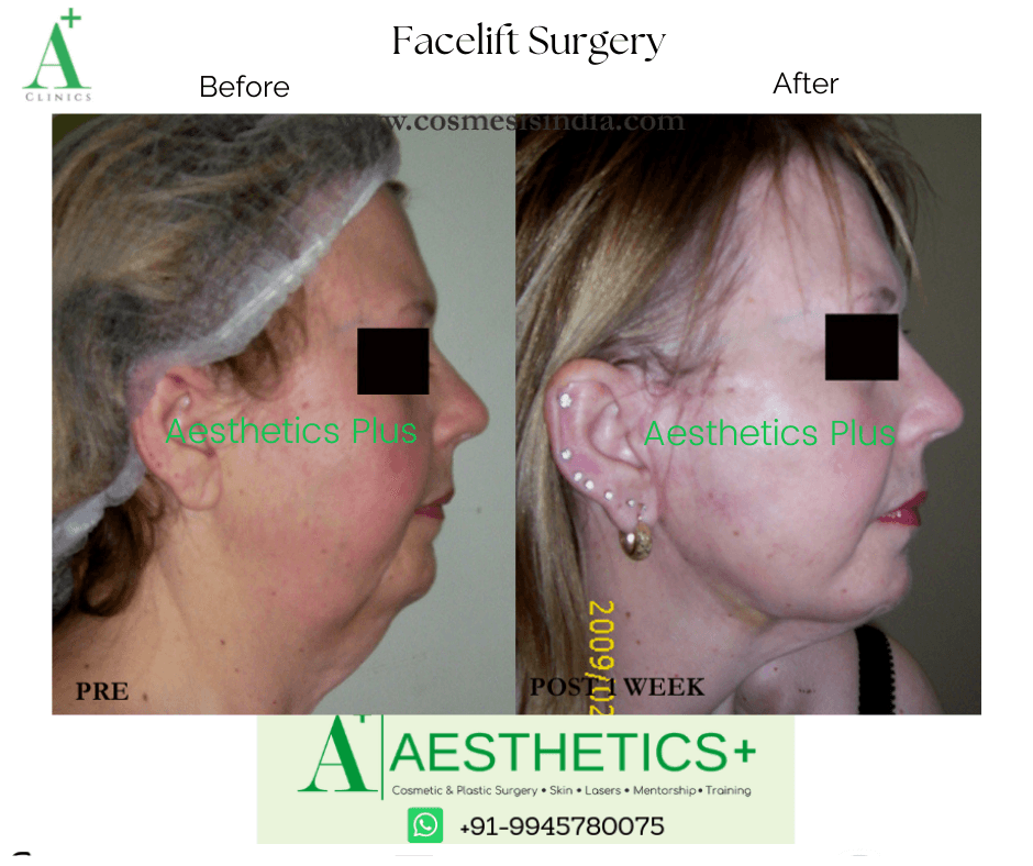 Facelift before and after result