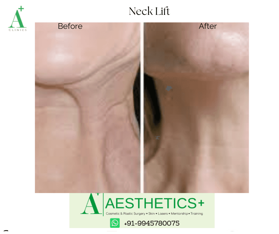 Neck Lift before and after result