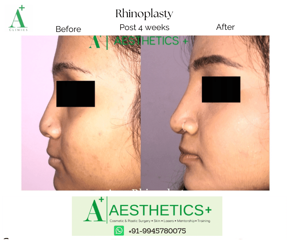 Rhinoplasty before and after result