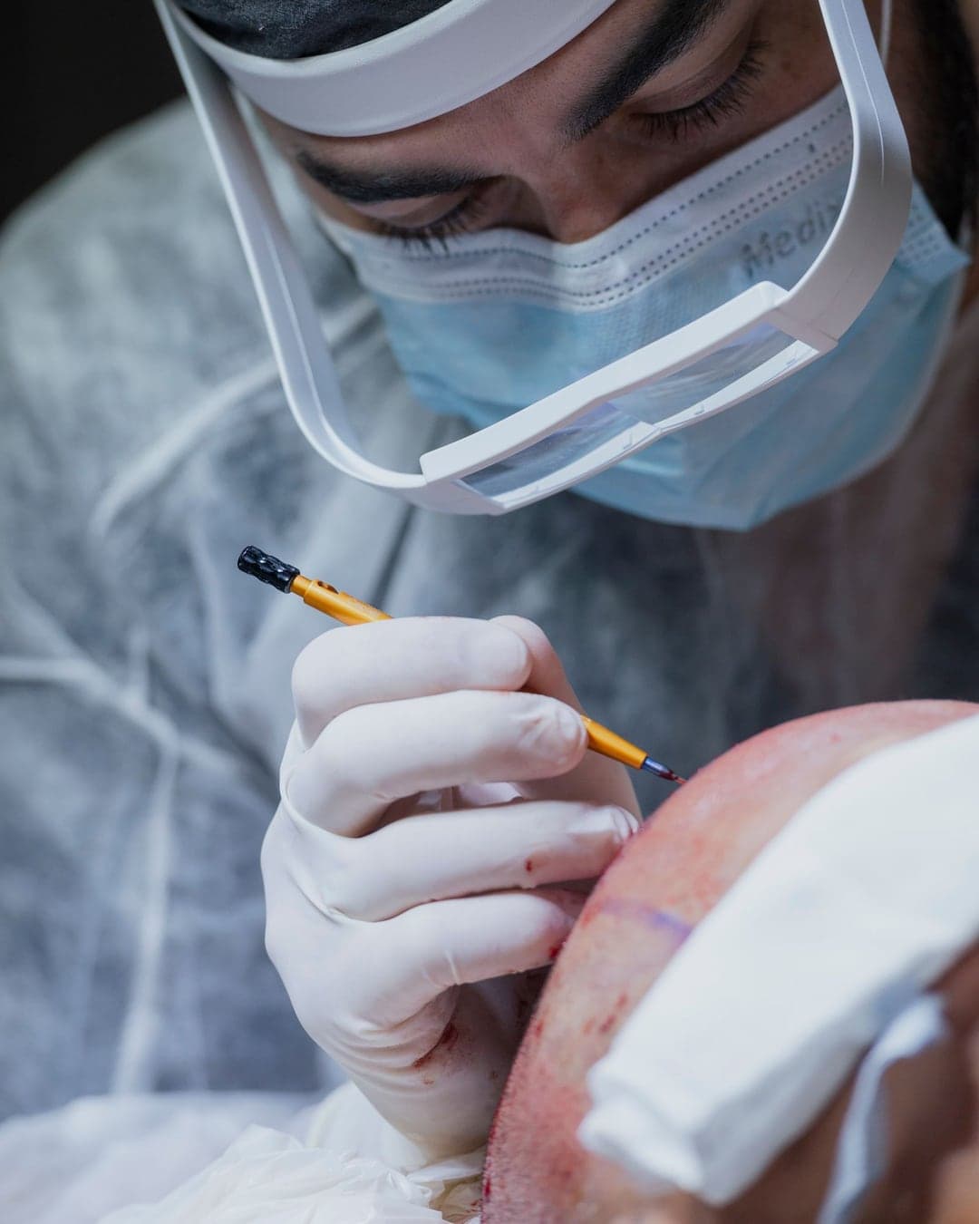 FUE Hair Transplant