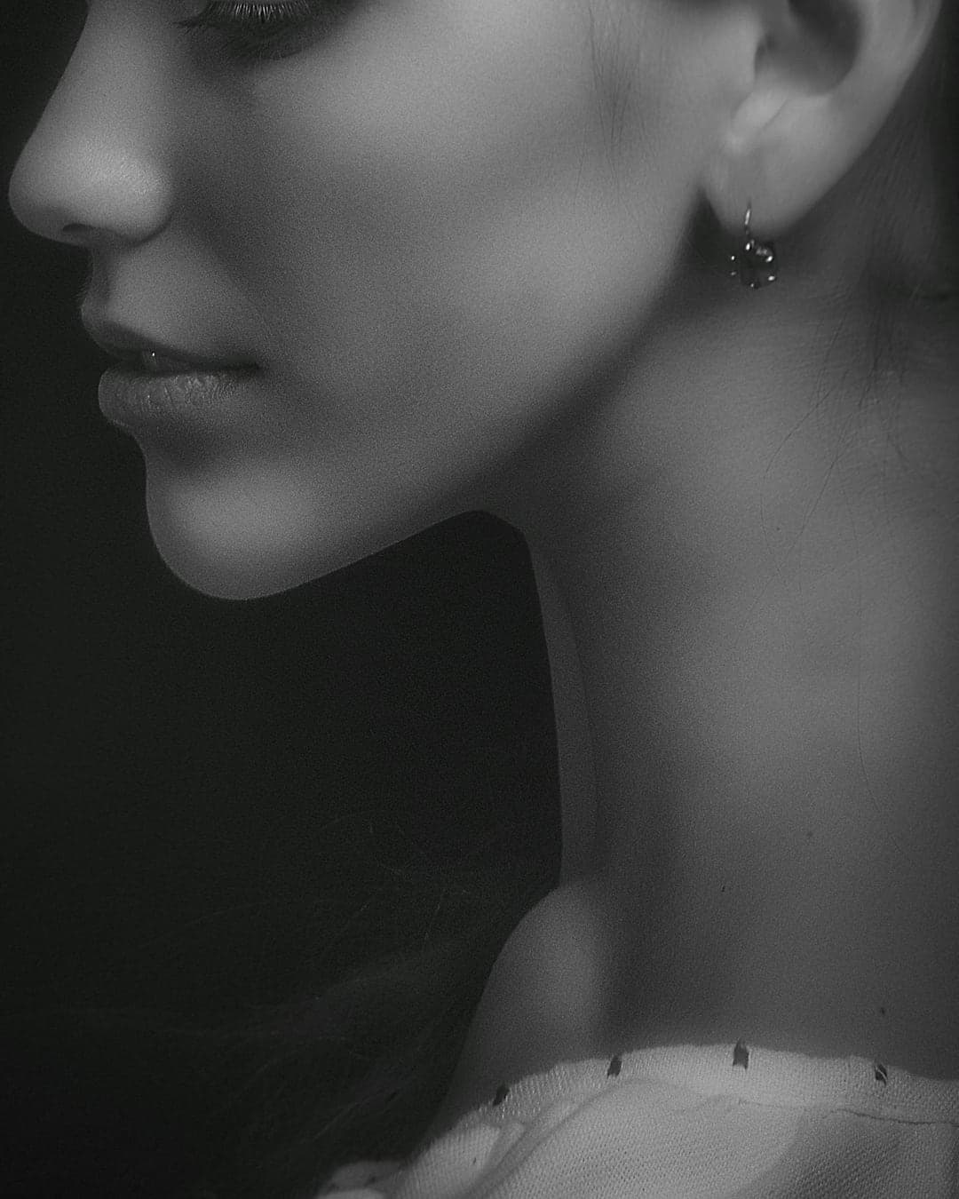 Rhinoplasty