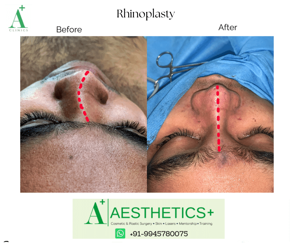 Rhinoplasty before and after result at Aesthetics Plus