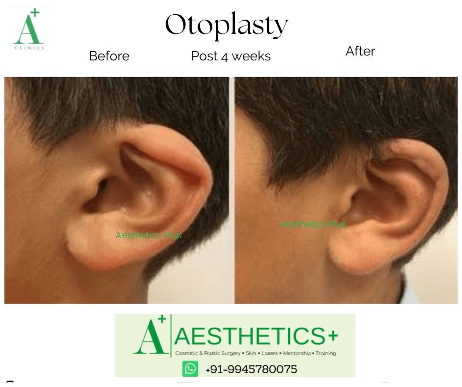 Otoplasty before and after result at Aesthetics Plus