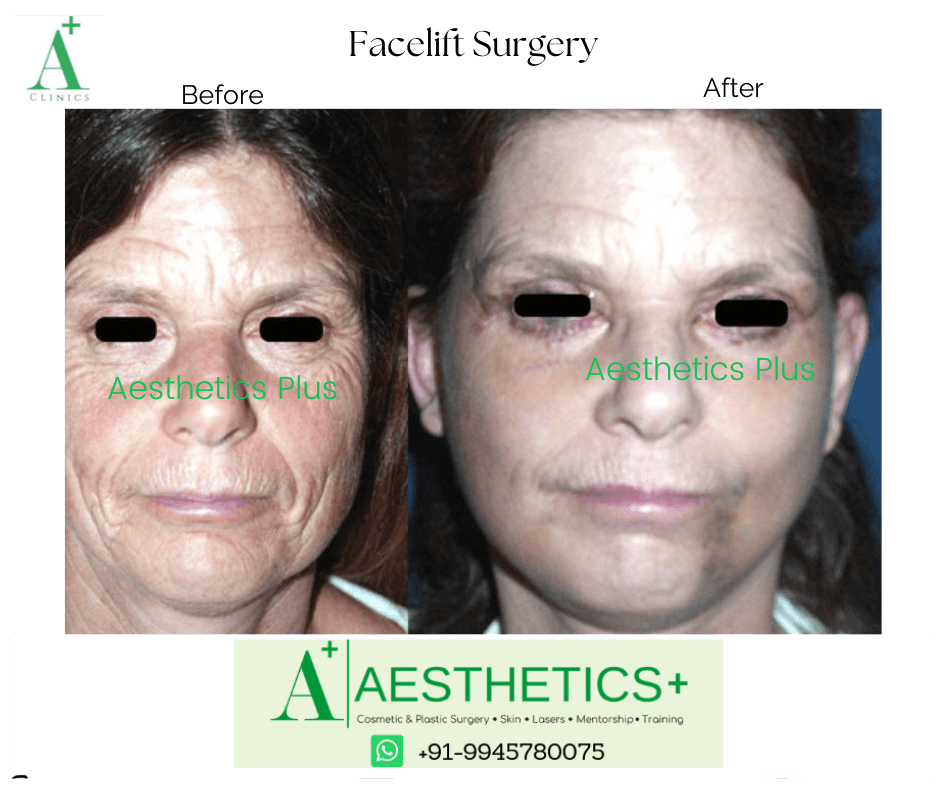 Facelift before and after result at Aesthetics Plus