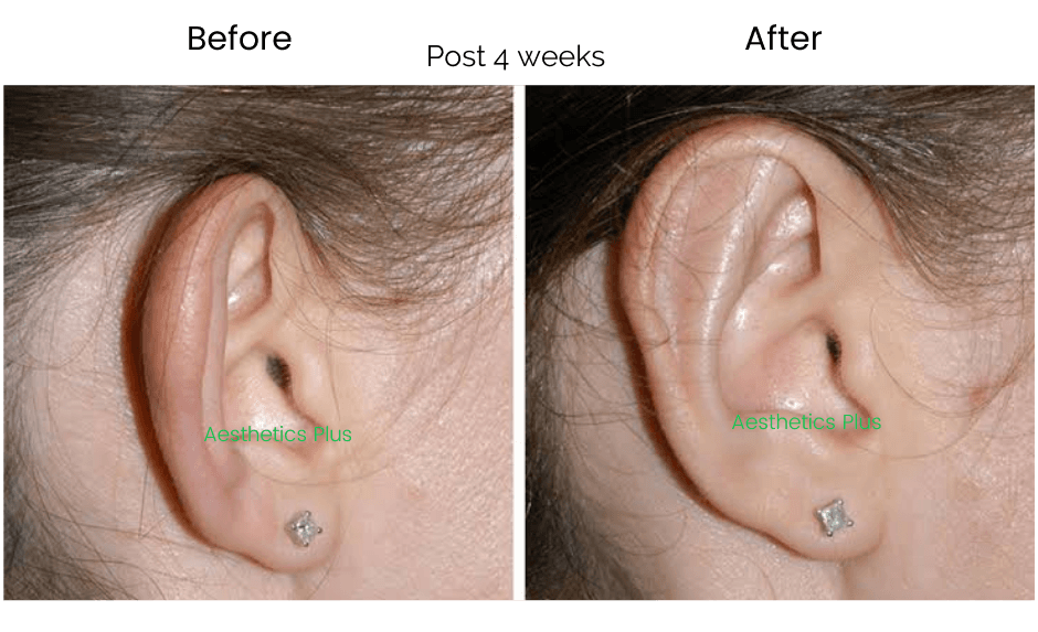 Otoplasty before and after result at Aesthetics Plus