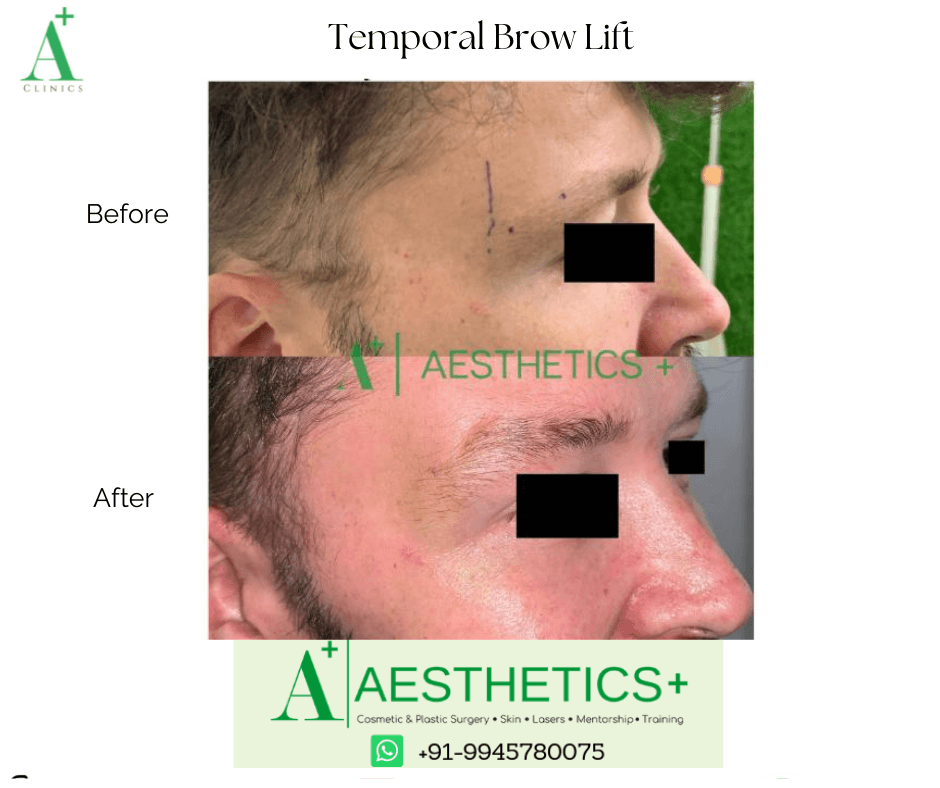 Temporal Brow Lift before and after result at Aesthetics Plus
