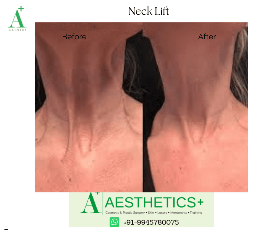 Neck Lift before and after result at Aesthetics Plus